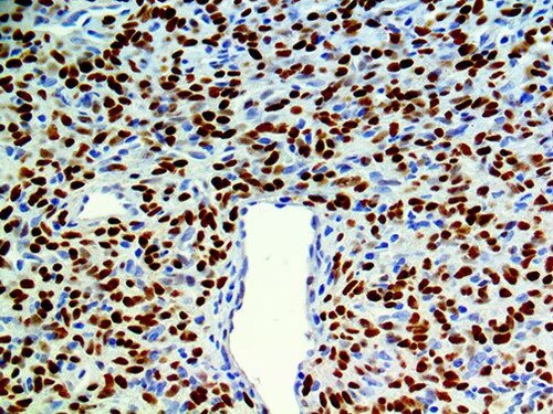 STAT6 Antibody Immunohistochemistry on a FFPE Solitary Fibrous Tumor Tissue